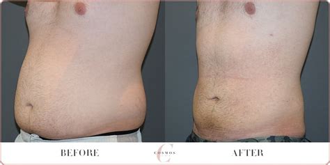 Mega Liposuction Before After Cosmos Clinic