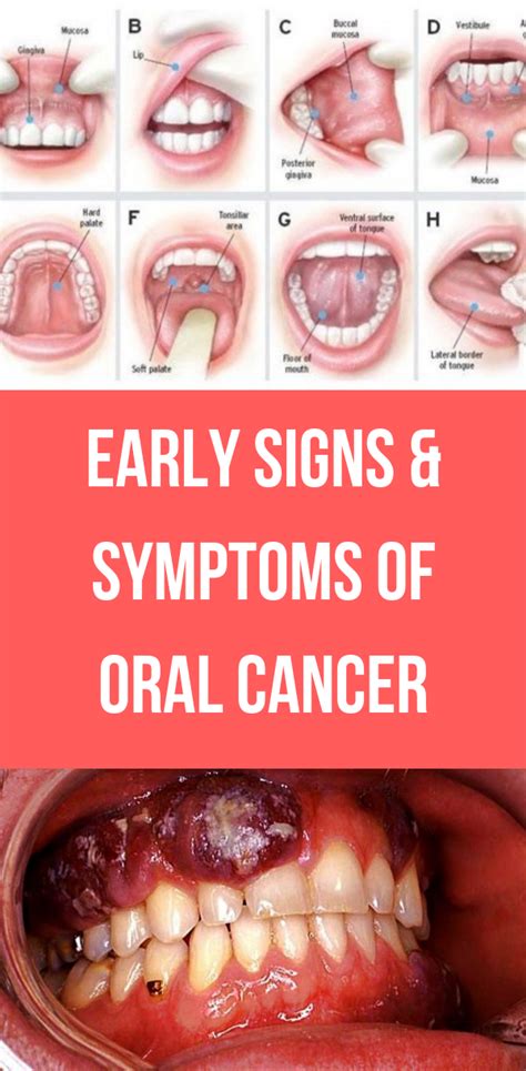 mouth cancer early warning signs