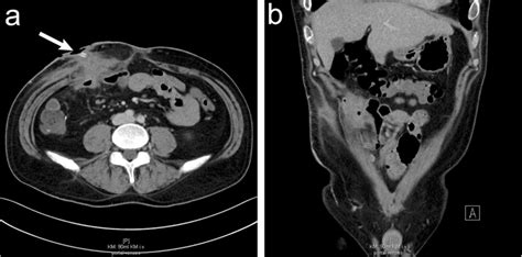 Contrast Enhanced Computed Tomography In Axial And Coronal Orientation