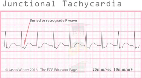 Ritmo Juncional No Ecg
