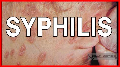 Syphilis Rash Stages