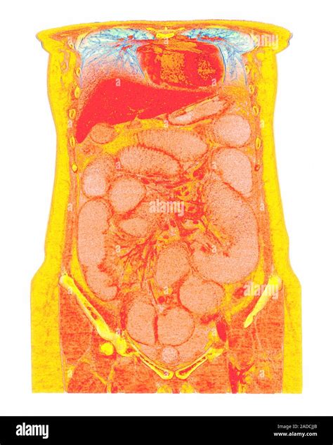 Intestinal Obstruction Coloured Coronal Computed Tomography Ct Scan