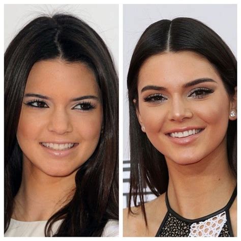 Kendall Kendall Jenner Plastic Surgery Kendall Jenner Nose Job