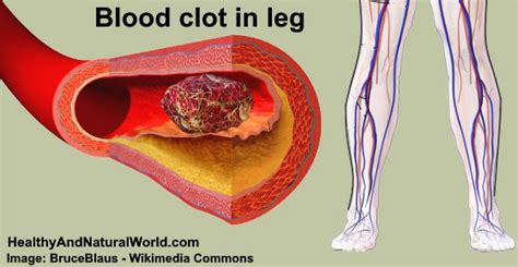 Blood Clot Inner Thigh