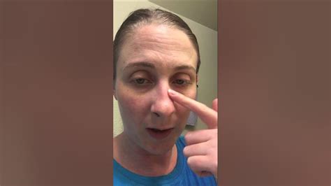 Day 2 Septoplasty And Bilateral Turbinate Reduction Surgery Recovery