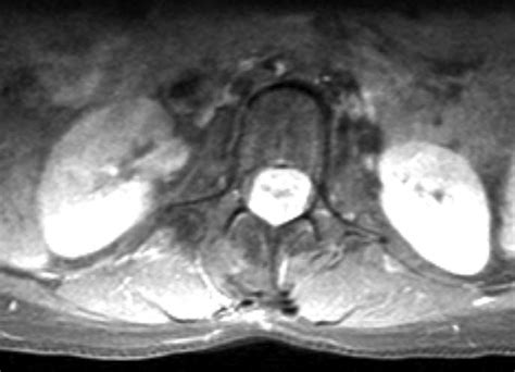 Axial T1 Mri Lumbar Spine Mr Imaging Post Gadolinium At The Level Of L1