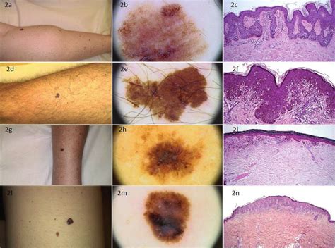 Four Cases Of Non Difficult To Diagnose Melanoma Nddm A D G L