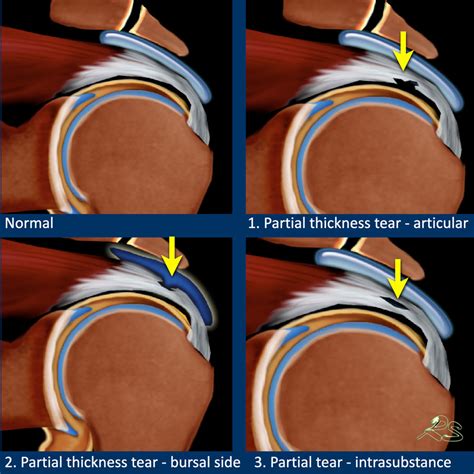 The Radiology Assistant Shoulder Rotator Cuff Injury