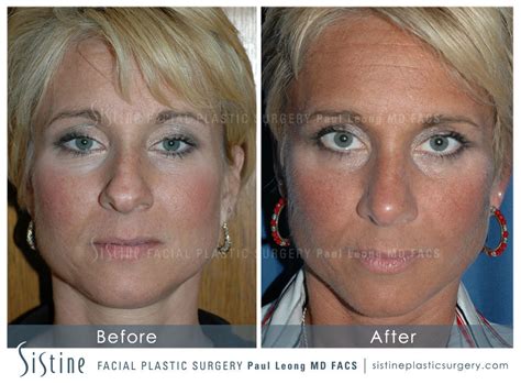 Nose Before And After 13 Sistine Facial Plastic Surgery