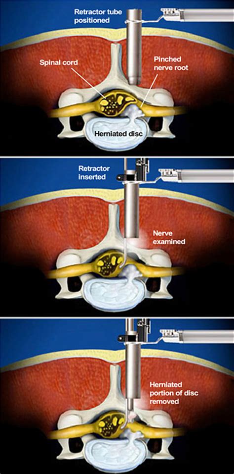 Micro Endoscopic Posterior Cervical Discectomy The Southeastern Spine