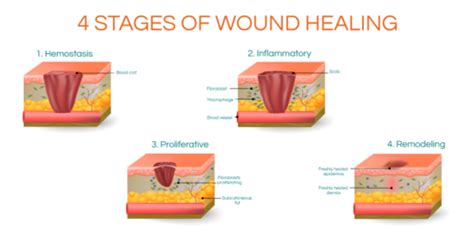 Ultrasound In Wound Healing Physiopedia