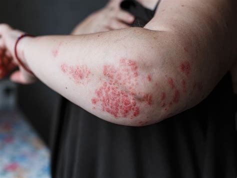 Psoriasis Symptoms Causes Treatment And Photos