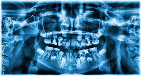 Different Types Of Wisdom Teeth Problems Concept Problem Teeth X Ray