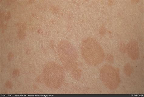 Stock Image Dermatology Pityriasis Versicolor Close Up Of Varied Oval