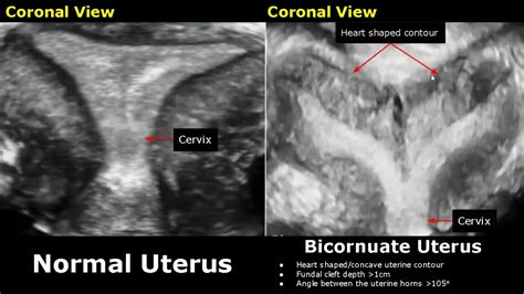 Congenital Uterine Abnormalities Ultrasound Normal Vs Abnormal Image