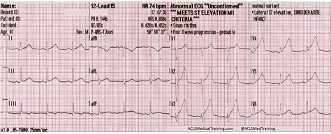 Chest Pain And Transient St Segment Elevation Acls Medical Training