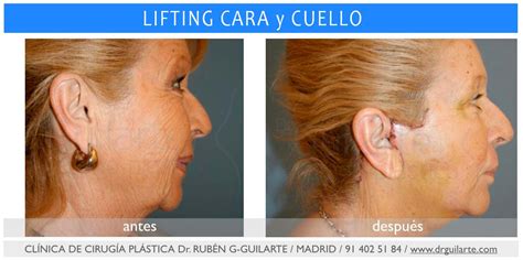 Lifting Facial Cervical Cuello Rostro Precios Madrid