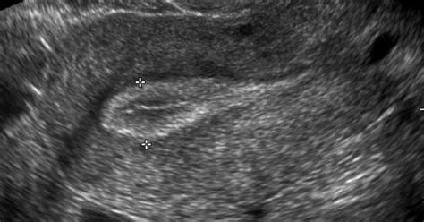 Wk 1 L 2 Normal Ut With Nabothian Cyst Transvaginal Ultrasound Shows