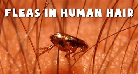 How Do You Get Rid Of Dog Fleas On Humans