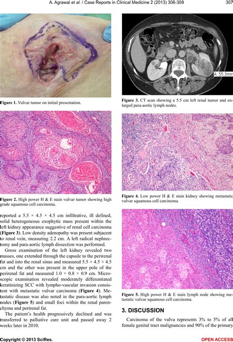A Case Of Kidney Metastasis In Vulvar Squamous Cell Carcinoma A Case
