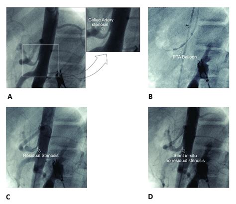 Percutaneous Balloon Angioplasty With Stent Placement For Celiac Artery