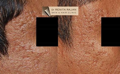 Acne Scar Revision Best Skin And Hair Clinic In Chennai Render Clinic