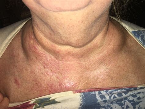 Swollen Lymph Nodes Above Collar Bone Images And Photos Finder