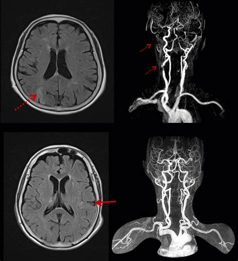 Magnetic Resonance Mr Imaging Of Patients With Ischemic Stroke And