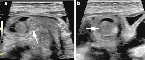 Figure 2 From Use Of Ultrasound In Diagnosing Postoperative Small Bowel