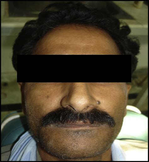 E Patient Showing Extraoral Swelling In Chin Region Download
