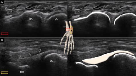 Ultrasound Imaging And Schematic Drawing Of The Distal Radioulnar Joint Download Scientific