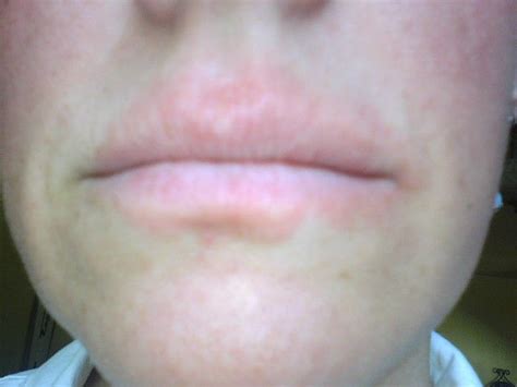 Allergic Reaction Bumps On Lips
