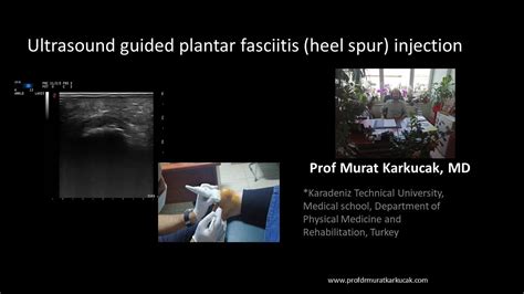 Ultrasound Guided Plantar Fasciitis Heel Spur Injection Youtube