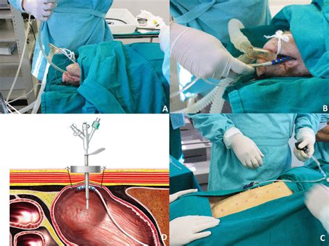 Percutaneous Magnetically Assisted Gastrostomy A Insertion Of A