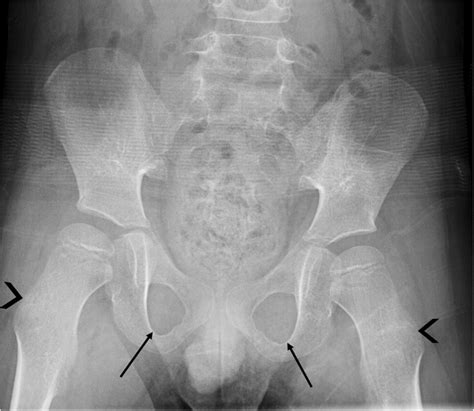 Appropriately Positioned Anteroposterior Ap Pelvis Radiograph