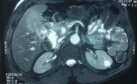 Cureus Gallbladder Tuberculosis Mimicking Gallbladder Carcinoma A