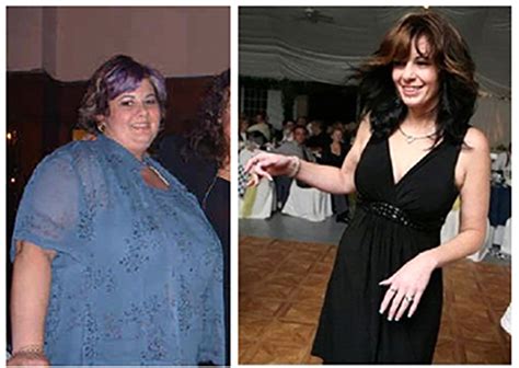 Obesity Surgery Made Her Beautiful Outside My Bariatric Life