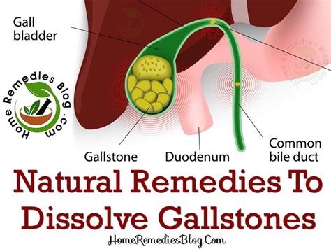 10 Best Home Remedies For Gallstones Treatment With Diet Plan Home