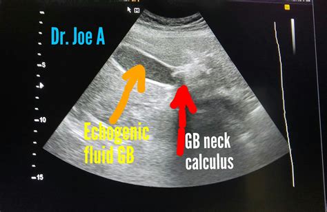 Ultrasound Imaging Mucocele Gallbladder 3d Ultrasound