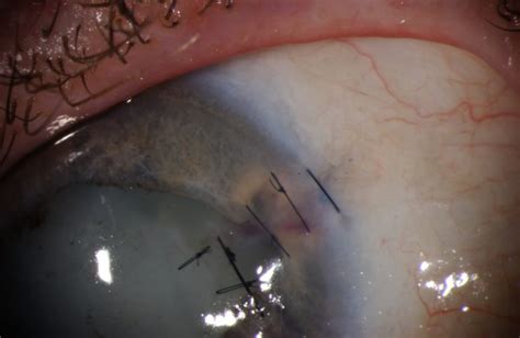Moran Core Removal Of Superficial Corneal Foreign Bodies