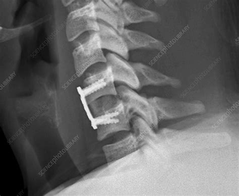 Cervical Vertebral Implant And Repair X Ray Stock Image C0403338