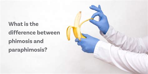 What Is The Difference Between Phimosis And Paraphimosis Circumcision Doctors