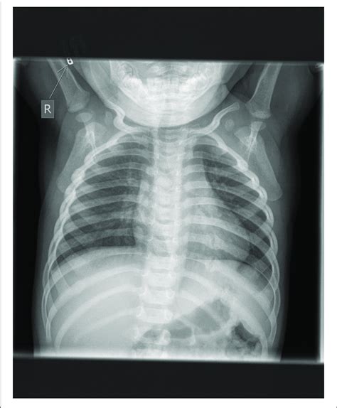 Chest X Ray Showing Multiple Rib Fractures From Child Abuse