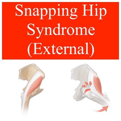 Dr Stacie Morris Dptusawfrc On Instagram “🎁 External Snapping Hip Syndrome 🎁 — — 📍snapping