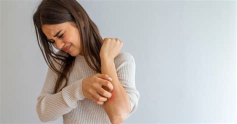 Should You Exfoliate With Eczema Professional Advice Dcsi