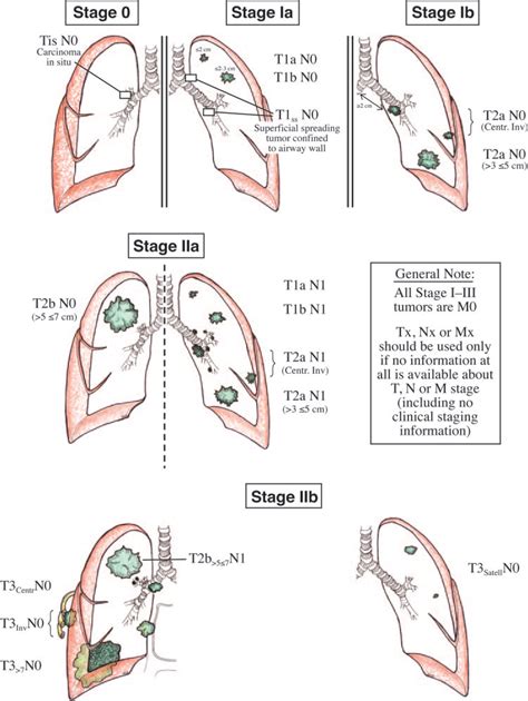 The New Lung Cancer Staging System Chest
