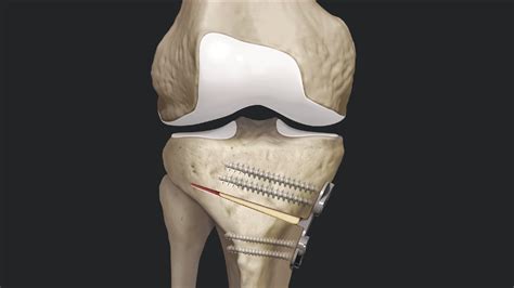 Arthrex High Tibial Osteotomy Using Tibial Opening Wedge Osteotomy