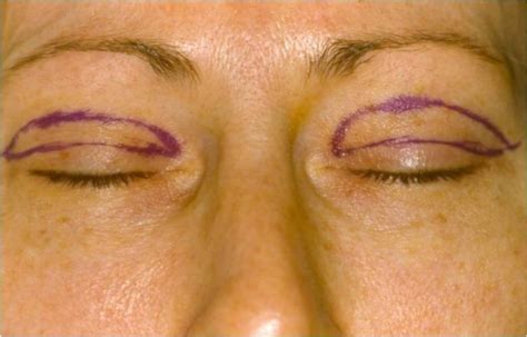 Upper Eyelid Surgery Evans Augusta Georgia Blepharoplasty