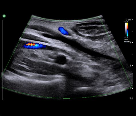 Laparoscopic Cholecystectomy The Clinical Value Of Intraoperative