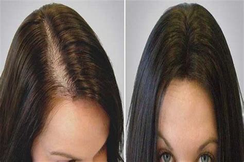 Saç Dökülmesine Ne İyi Gelir Kesin Çözümlü - Tarz Kadın